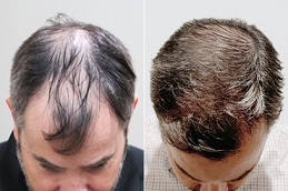fue hair transplant in abu dhabi 