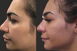 Jawline Filler Injections 5 jawline filler injection in abu dhabi
