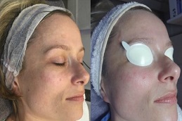 Mesotherapy Treatment 8 mesotherapy in abu dhabi