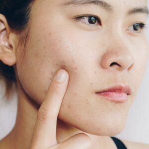 Blog 1 HydraFacial for Acne Scars