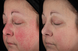 before and after Rosacea Treatment in abu dhabi & al ain