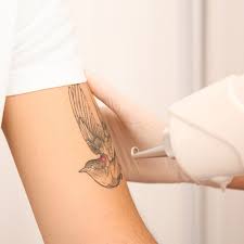 Blog 1 Picosure Tattoo Removal cost in abu dhabi