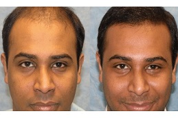 before & after hair transplant in al ain
