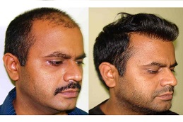 hair transplant before and after