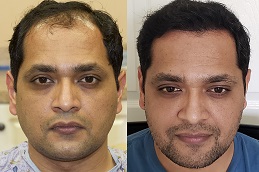 hair transplant in Al Ain before & after