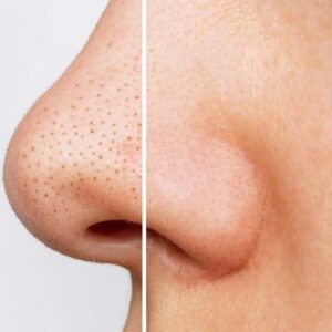 Blog 3 Hydra Facial for Blackheads: A Non-Invasive Solution for Clear Skin