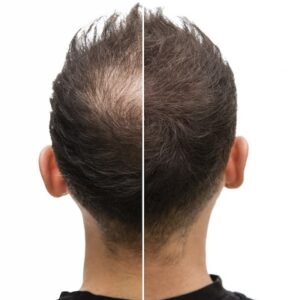 Blog 1 Scalp Micropigmentation cost in abu dhabi