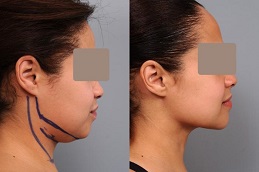Chin liposuction before and after in Abu Dhabi