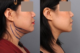 Chin Liposuction 8 Chin liposuction in Abu Dhabi