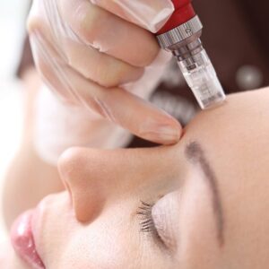 Blog 5 How much does it cost to get microneedling