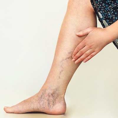 Sclerotherapy in Abu Dhabi