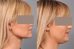 before and after chin liposuction in abu dhabi