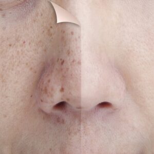 Blog 1 3 Major Things to Know About Pico Laser Treatment