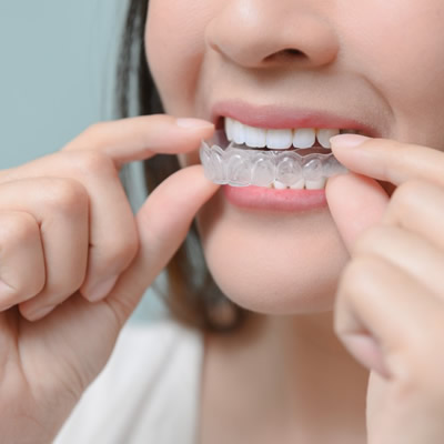 Invisalign Braces Treatment in Abu Dhabi & Al Ain | Cost & Price (