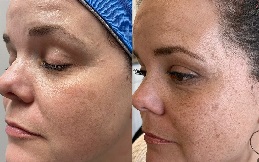 Microneedling treatment in abu Dhabi before & after