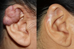 before and after keloid treatment in abu dhabi