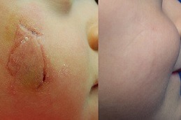 before and after keloid treatment