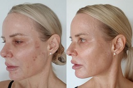 before and after microneedling in abu dhabi