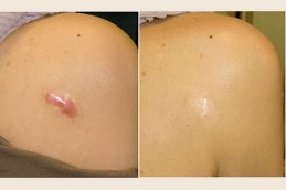 keloid treatment in abu dhabi before & afteri