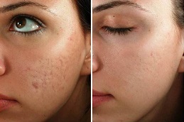 microneedling in abu dhabi before and after