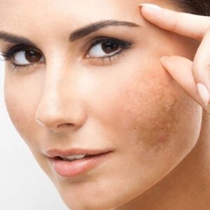 Melasma Treatment Cost in Abu Dhabi