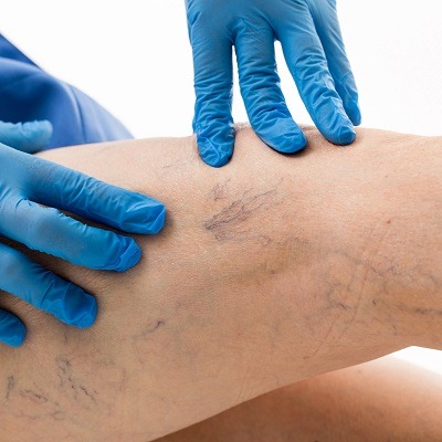 Sclerotherapy Cost in Abu Dhabi