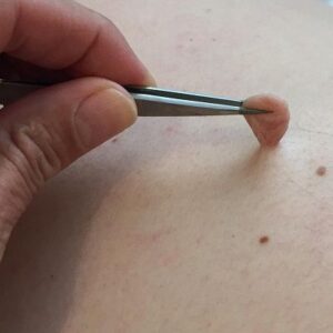 Skin Tag Removal Cost in Abu Dhabi