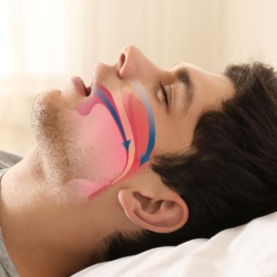 Snoring Treatment Cost in Abu Dhabi