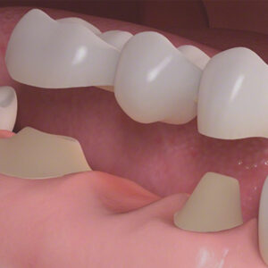 Blog 5 Dental Bridge Cost in UAE