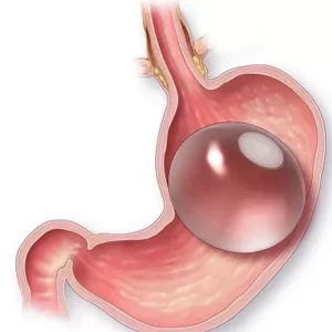 Blog 17 Gastric Balloon price uae
