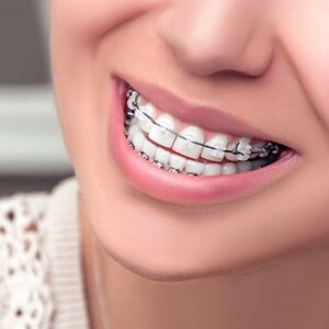 Blog 7 Metal Braces Cost UAE
