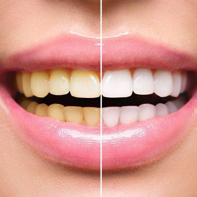 Teeth Whitening Price in Abu Dhabi 10 Teeth Whitening Price in Abu Dhabi
