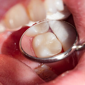 Blog 3 Tooth Filling Cost in UAE