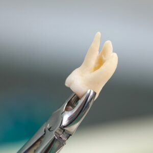 Blog 1 Wisdom Tooth Extraction Cost UAE