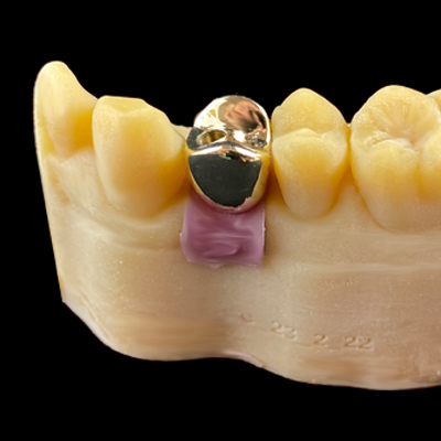 Gold Crowns in Abu Dhabi