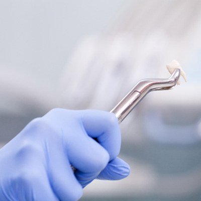 Tooth Extraction Cost UAE