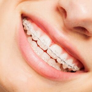 Blog 1 Ceramic Braces Cost in Abu Dhabi