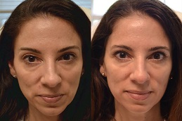 Eyelid Surgery | Blepharoplasty 8 Eyelid surgery before and afer