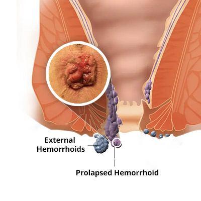 Hemorrhoids Treatment Cost in Abu Dhabi 2 Hemorrhoids Treatment Cost in Abu Dhabi