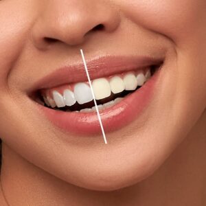 Blog 7 How Teeth whitening is done