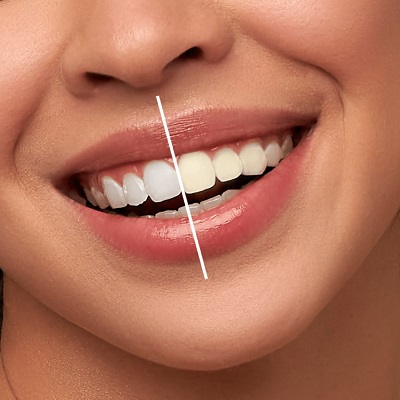 How Teeth Whitening is Done 9 How Teeth whitening is done