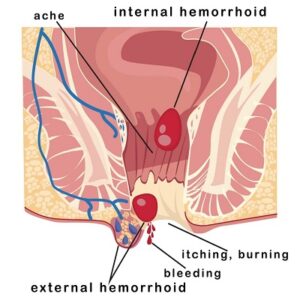 Blog 3 Laser treatment for hemorrhoids