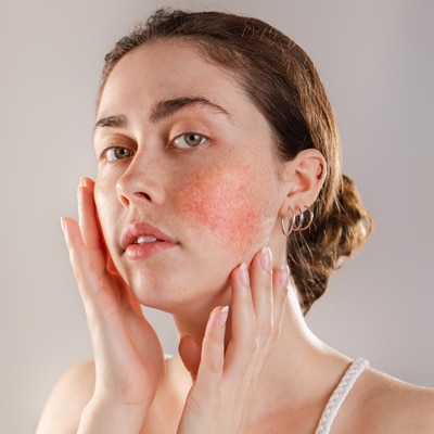 Rosacea Laser Treatment Cost