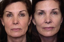 before and afte of facelift in abu dhabi