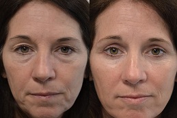 before and after Eyelid Surgery Abu Dhabi