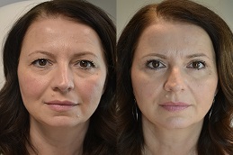 before and after Eyelid surgery