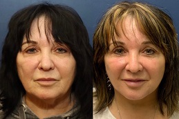 before anf after facelift abu dhabi