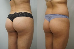 butt lift before and after