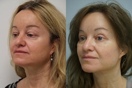 Facelift Abu Dhabi 8 facelift abu dhabi before and after