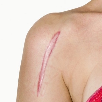 Keloid removal cost in Abu Dhabi